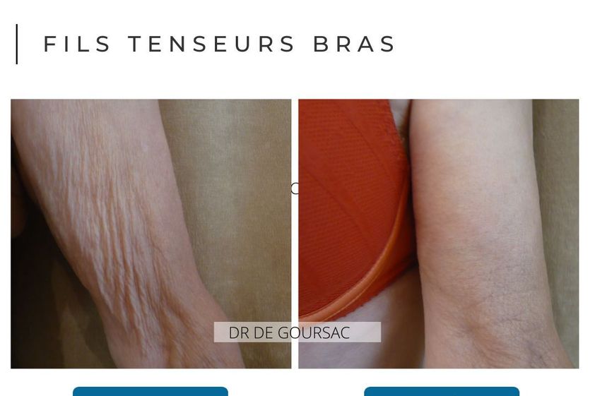 Fils tenseurs avant et après - 876300