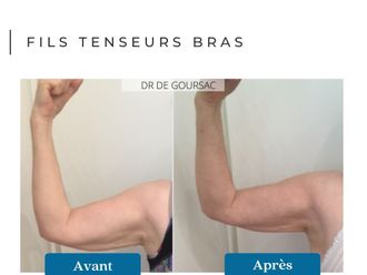 Fils tenseurs avant et après - 876301