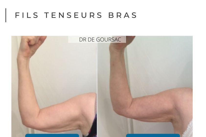 Fils tenseurs avant et après - 876301