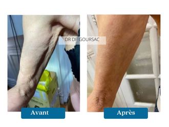 Fils tenseurs avant et après - 876303