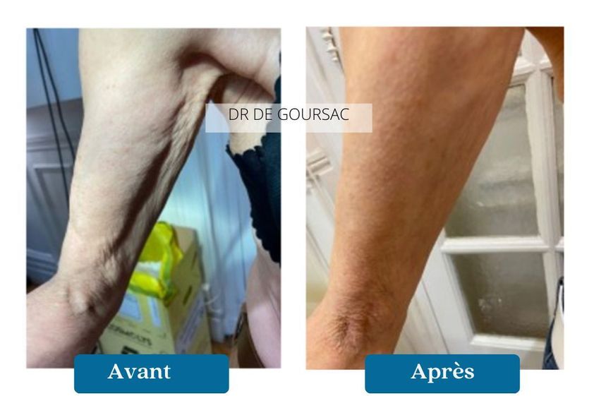 Fils tenseurs avant et après - 876303