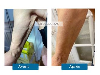 Fils tenseurs avant et après - 876304