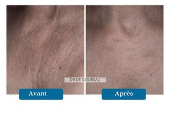 Mésolift avant et après - 876801