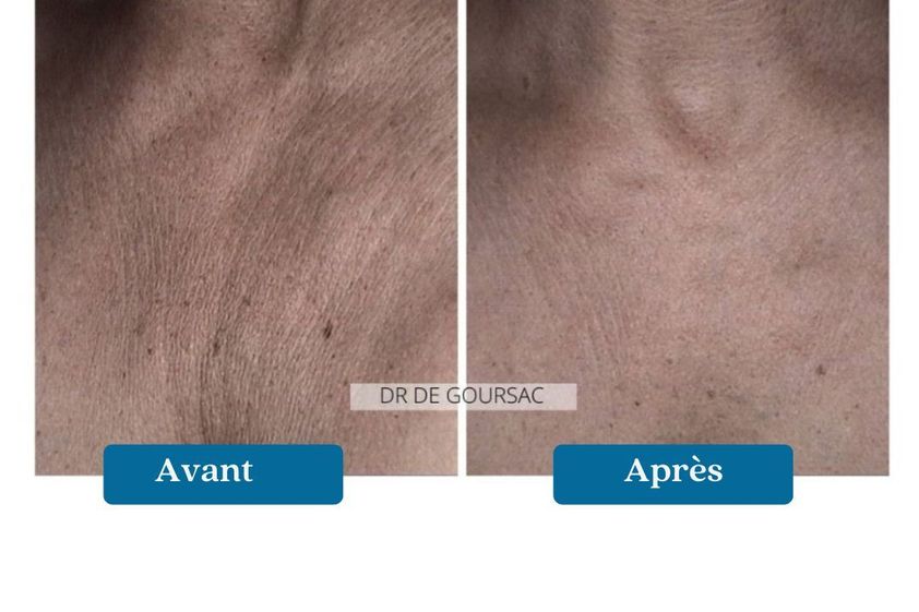Mésolift avant et après - 876801