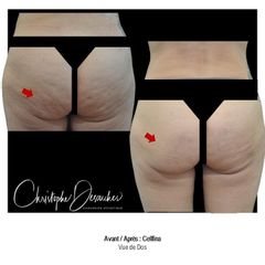Traitement anti-cellulite - Dr Christophe Desouches