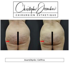 Traitement anti-cellulite - Dr Christophe Desouches