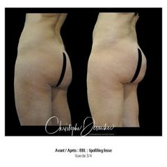 Chirurgie des fesses - Dr Christophe Desouches