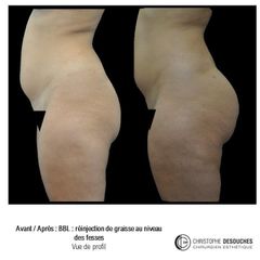 Chirurgie des fesses - Dr Christophe Desouches