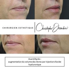 Augmentation des lèvres - Dr Christophe Desouches