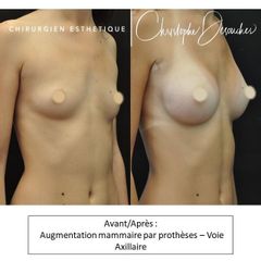Augmentation mammaire - Dr Christophe Desouches