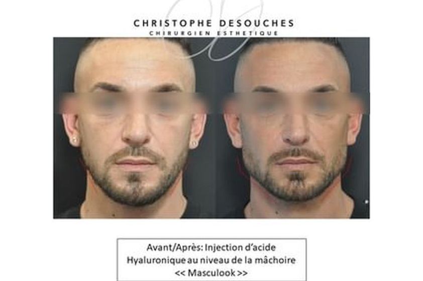 Acide Hyaluronique avant et après - 812808