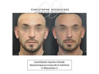 Acide Hyaluronique - Dr Christophe Desouches