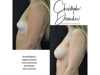Augmentation mammaire - Dr Christophe Desouches