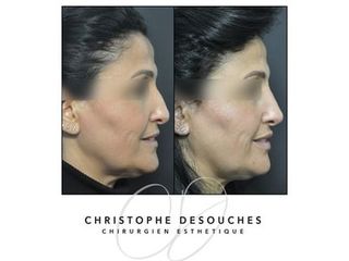 Rhinoplastie - Dr Christophe Desouches