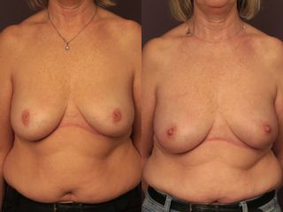 Mamelon ombiliqué - Dr Virginie Berard