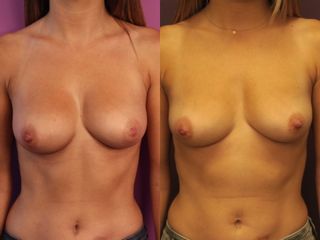 Mamelon ombiliqué - Dr Virginie Berard