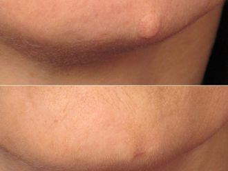 Grains de beauté avant et après - 874365
