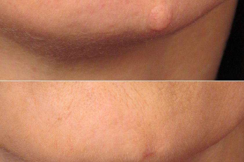 Grains de beauté avant et après - 874365