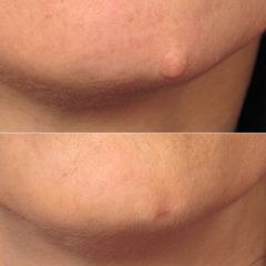NAEVUS TUBÉREUX MENTON- Dr Virginie BERARD