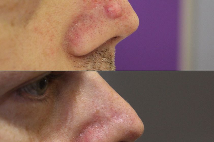 Grains de beauté avant et après - 874366