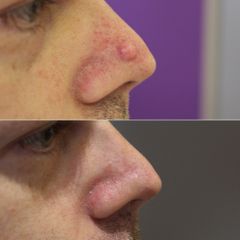 TUMEUR NEZ- Dr Virginie BERARD