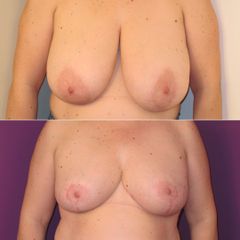 HYPERTROPHIE MAMMAIRE- Dr Virginie BERARD