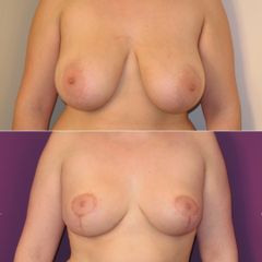 HYPERTROPHIE MAMMAIRE- Dr Virginie BERARD