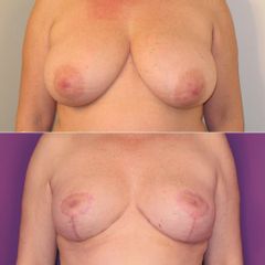 HYPERTROPHIE MAMMAIRE- Dr Virginie BERARD