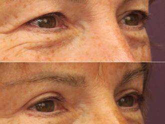 Blépharoplastie avant et après - 874413