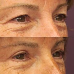 BLEPHAROPLASTIE- Dr Virginie BERARD