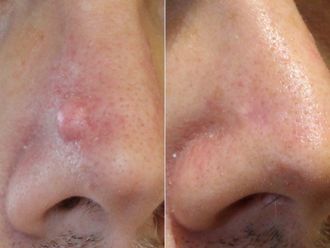 Grains de beauté avant et après - 874414
