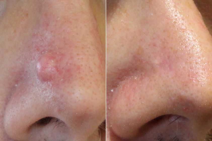 Grains de beauté avant et après - 874414