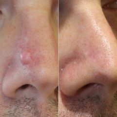 TUMEUR NEZ- Dr Virginie BERARD