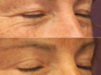 Blépharoplastie avant et après - 874415