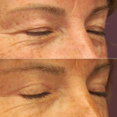 BLEPHAROPLASTIE- Dr Virginie BERARD