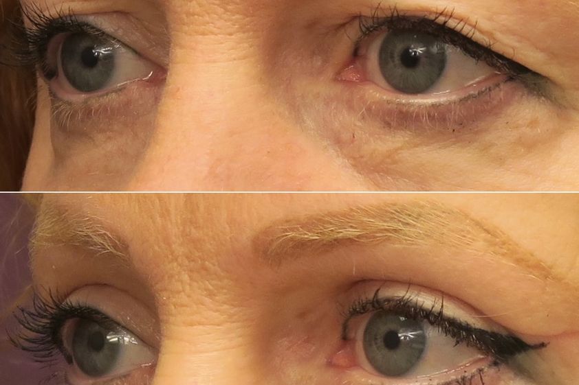 Blépharoplastie avant et après - 874417