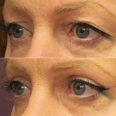 BLEPHAROPLASTIE-Dr Virginie BERARD