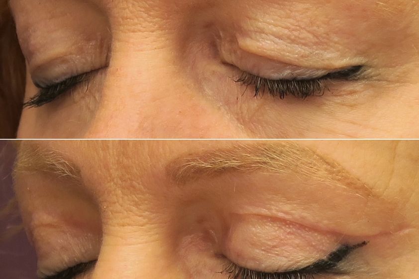 Blépharoplastie avant et après - 874418