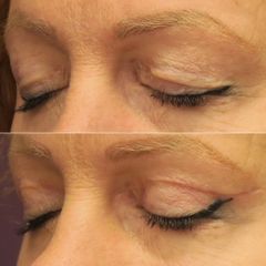 BLEPHAROPLASTIE-Dr Virginie BERARD