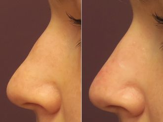 Rhinoplastie médicale avant et après - 874455