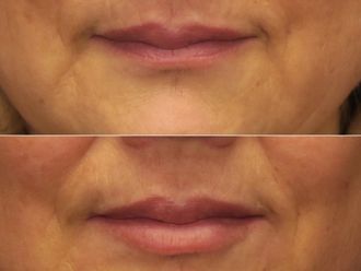 Augmentation des lèvres avant et après - 874673