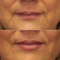 AUGMENTATION LÈVRES AH - Dr VIRGINIE BERARD