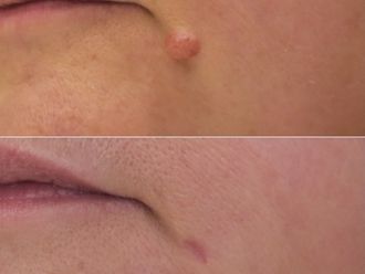 Grains de beauté avant et après - 874973