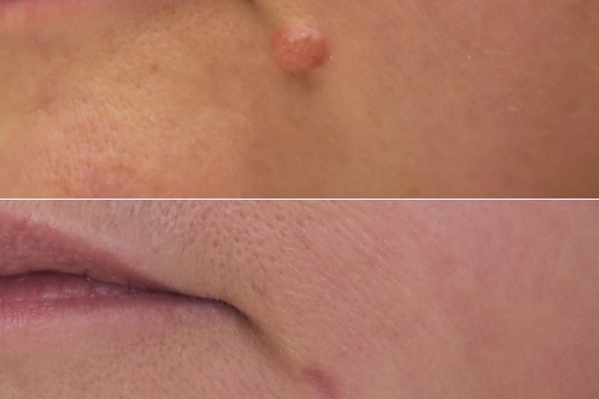 Grains de beauté avant et après - 874973
