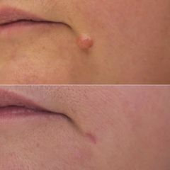 Naevus-Dr Virginie BERARD
