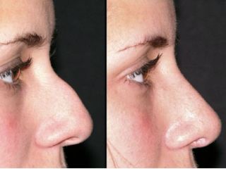 Avant après Rhinoplastie