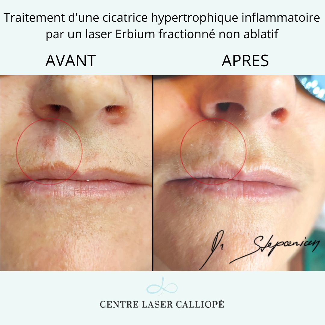 Traitement Cicatrice Avant Et Apr s Multiesthetique fr