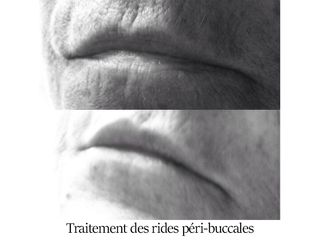 Traitement des rides péri-buccales - Dr Brigitte Dautel