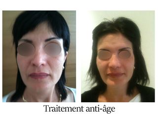 Traitement anti-âge - Dr Brigitte Dautel