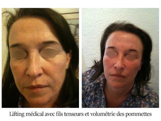 Lifting médical avec fils tenseurs et volumétrie des pommettes - Dr Brigitte Dautel